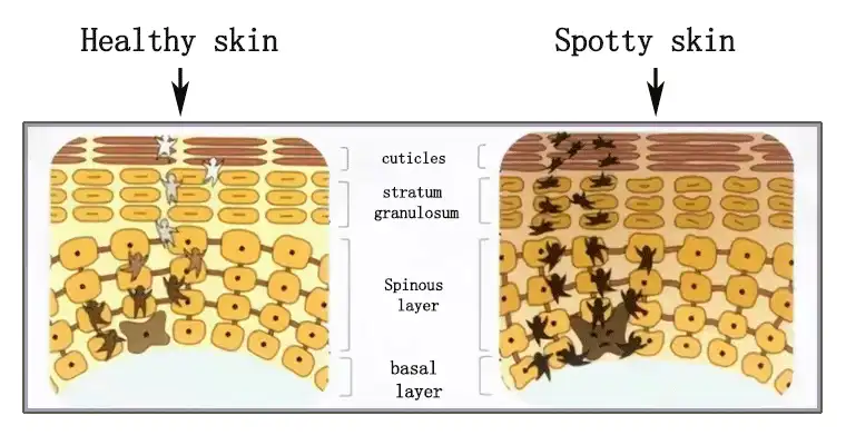 Spinous-layer-w.gif