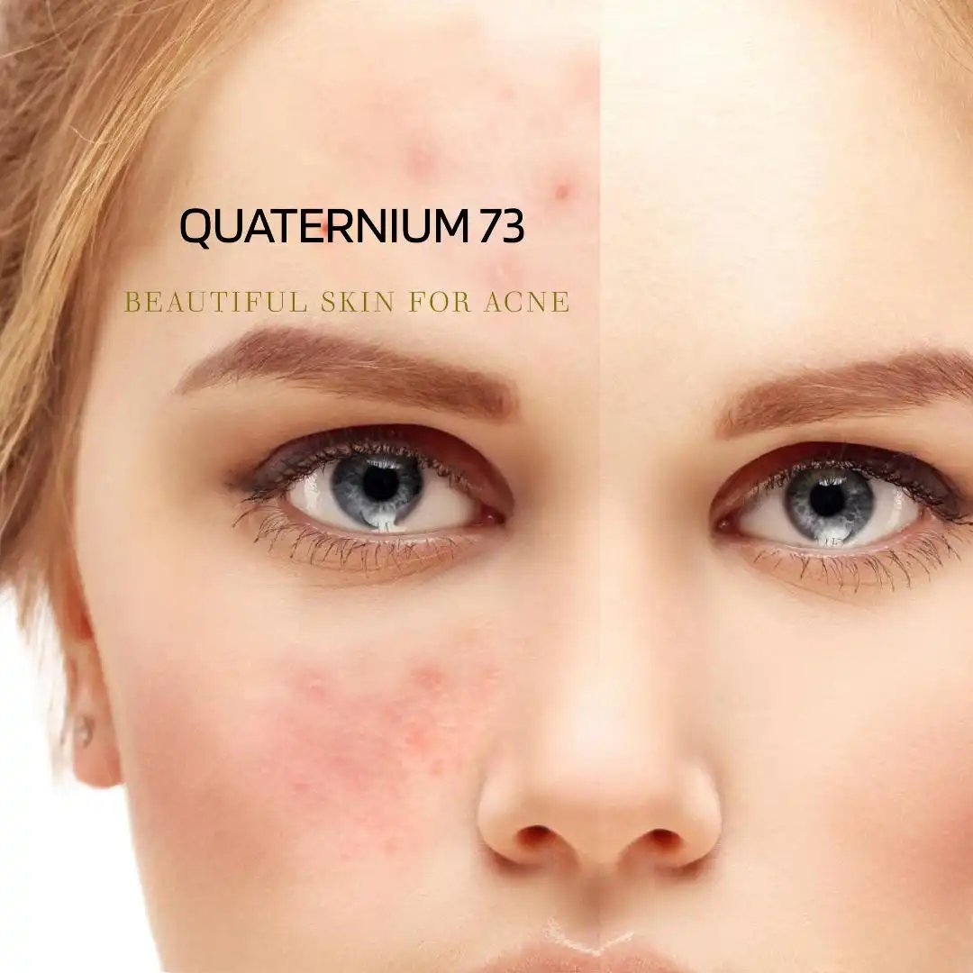 Quaternium -73-for-acne Quaternium -73-for-acne